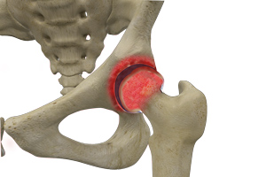 Inflammatory Arthritis pic