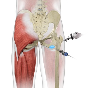 Ischial Bursectomy pic