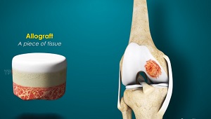 Osteochondral Allograft pic