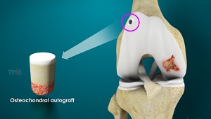 Osteochondral Autograft pic