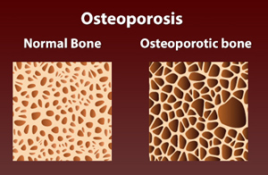 Osteoporosis pic
