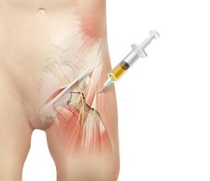 Platelet Rich Plasma (PRP) Injections for the Hip pic