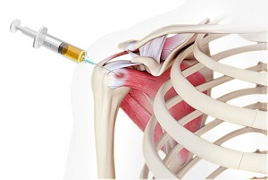 Platelet-Rich Plasma (PRP) for the Shoulder pic