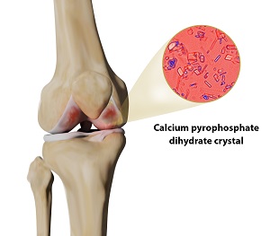 Pseudogout pic