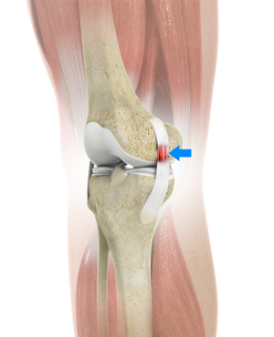 Sprains and Strains pic