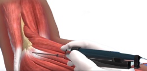 Tenex FAST Procedure pic