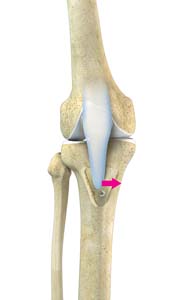 Tibial Tubercle Osteotomy pic