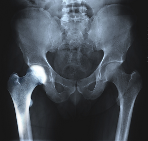 Transient Osteoporosis of the Hip pic