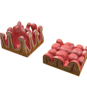 Picture of Coeliac Disease