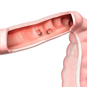 Picture of  Colonic Polyps