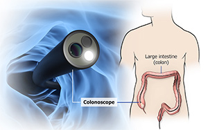 Picture of Colonoscopy