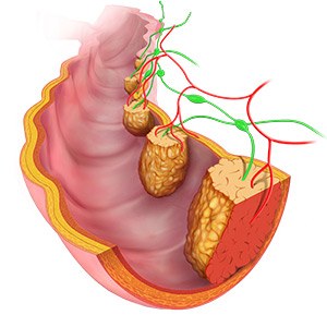 Picture of Colorectal Cancer