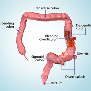 Picture of Diverticular Disease