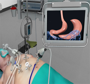 Laparoscopic Sleeve Gastrectomy Images