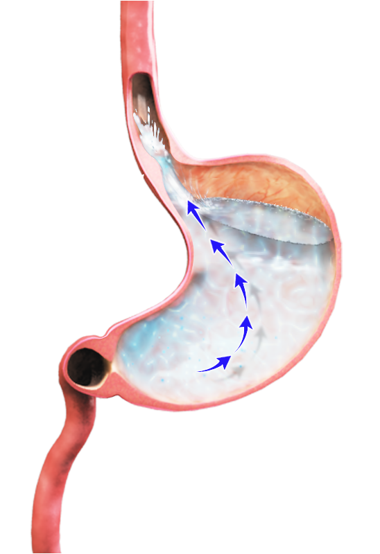 Acid Reflux Images
