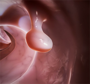 Colon and Rectum Polyps Images