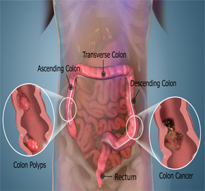 Colon Cancer Images
