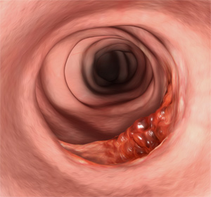 Colorectal Cancer Images