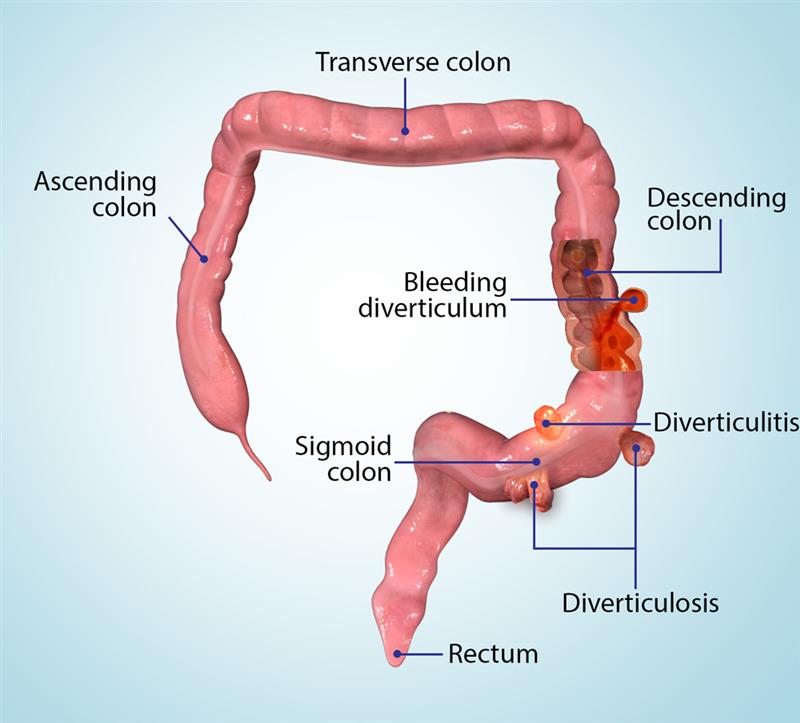 Diverticular Colitis Images