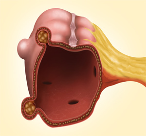 Diverticulitis Images