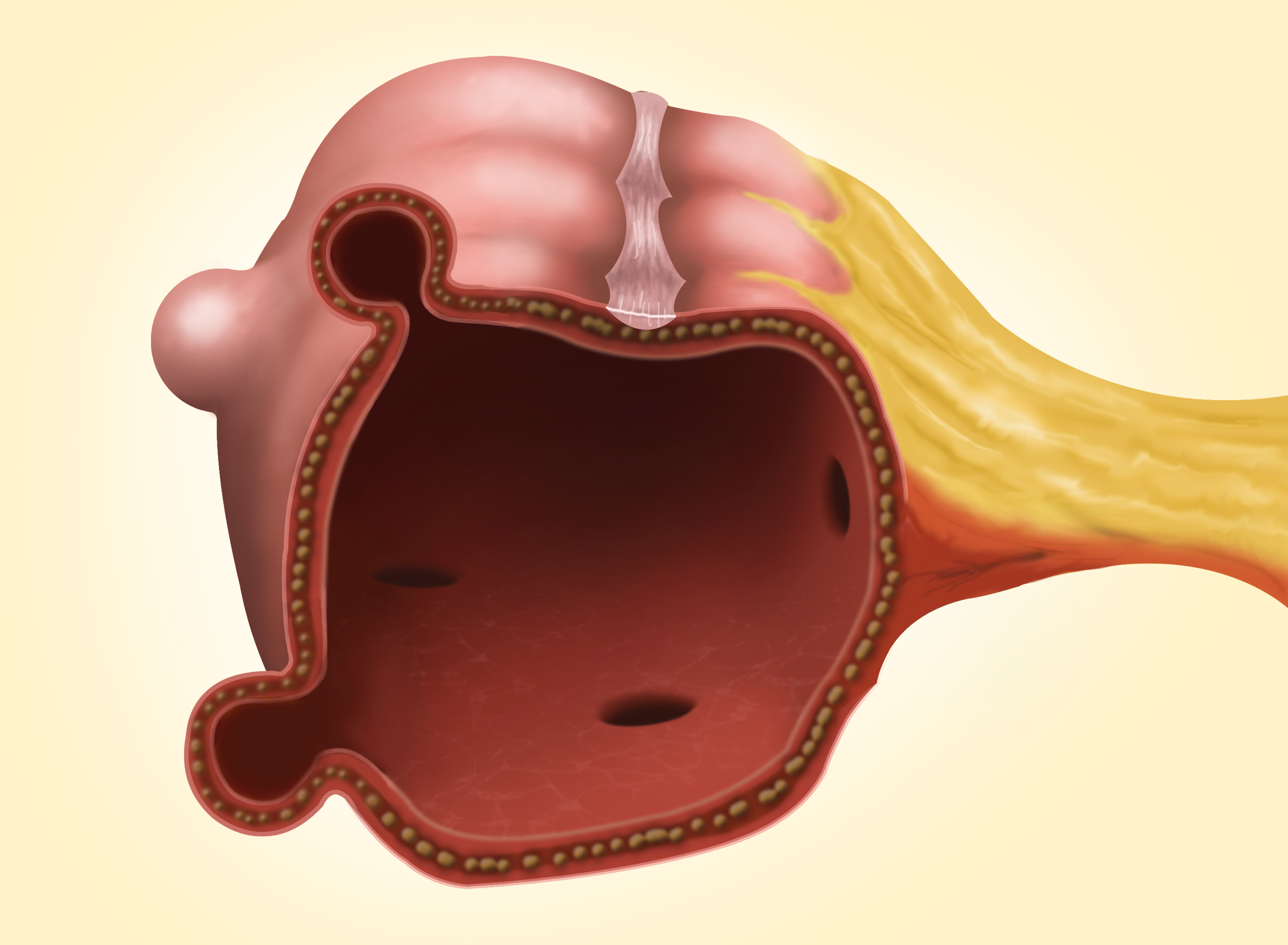 Diverticulosis Images