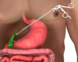 Gallbladder Surgery Images