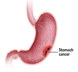 Gastric Cancer Images