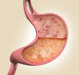 Gastritis Images