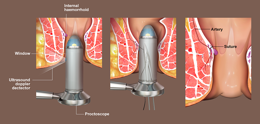 Hemorrhoidectomy Images