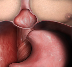 Hiatal Hernia Images