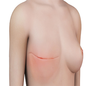 Mastectomy Images