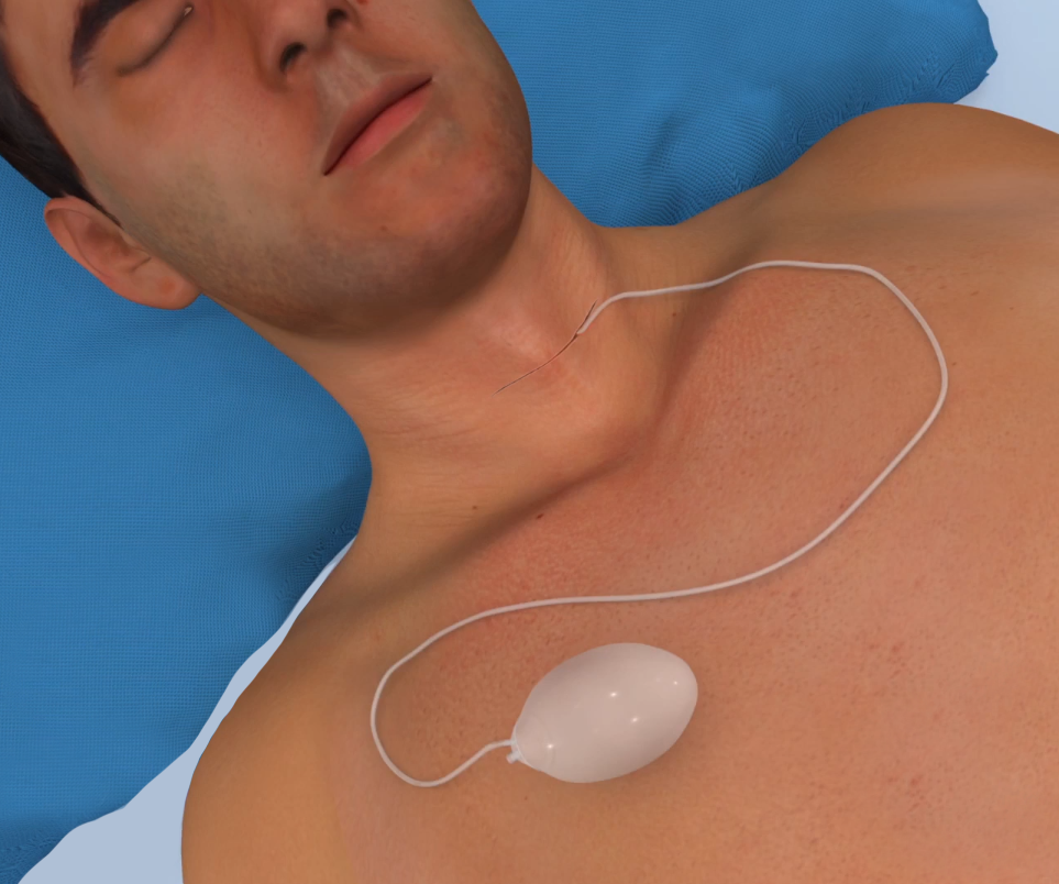 Thyroid Surgery Images