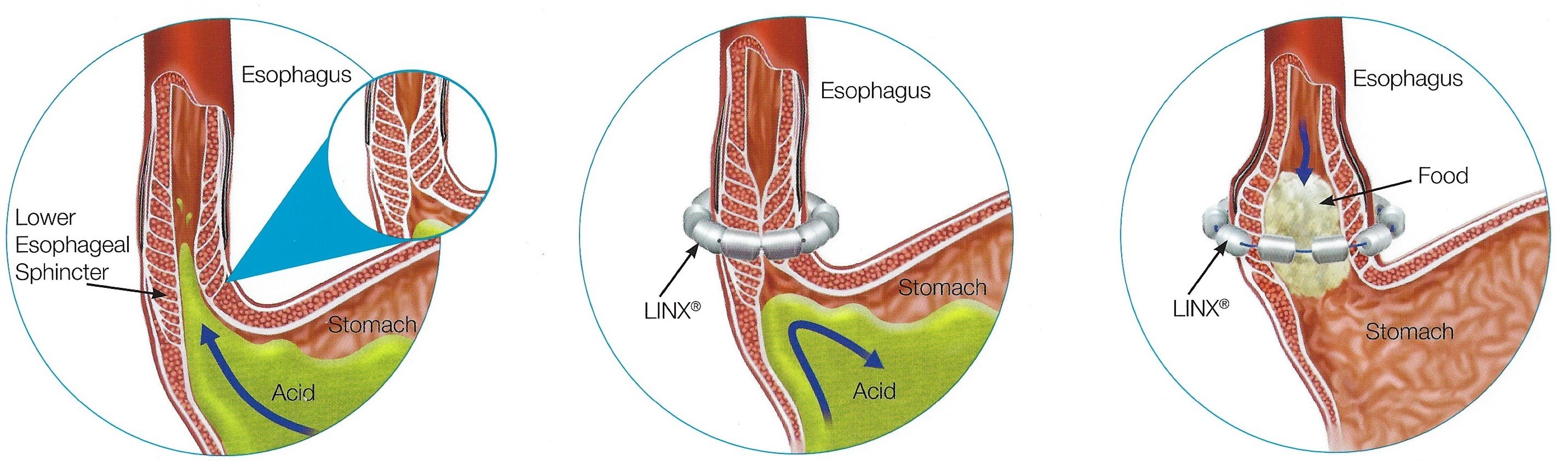 Lower Esophageal Sphincter Image