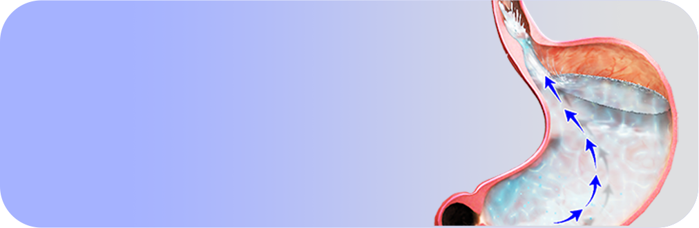 Reflux Surgery Images