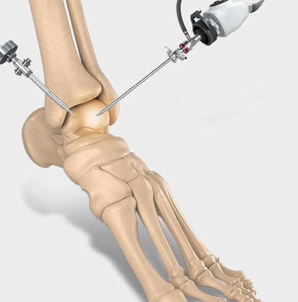 Ankle Arthroscopy