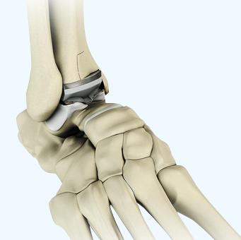 Total Ankle Arthroplasty