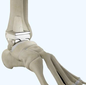 Salto Talaris Total Ankle Arthroplasty