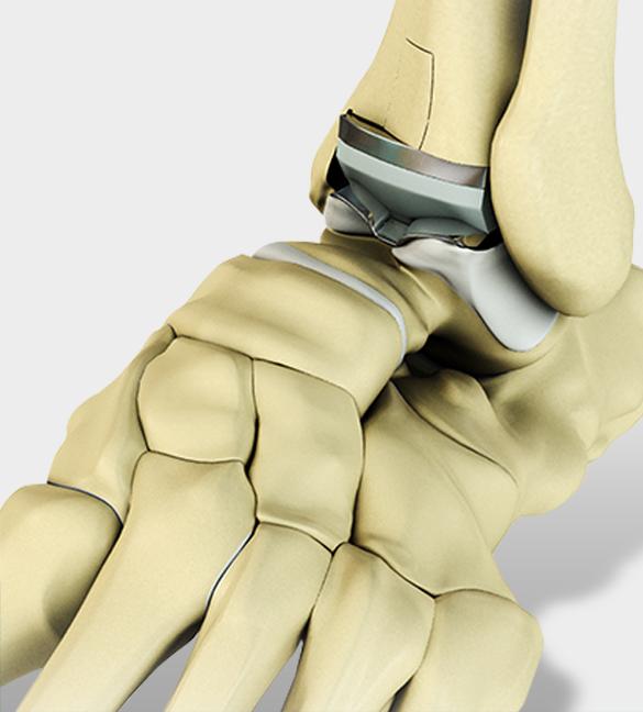 Total Ankle Replacement