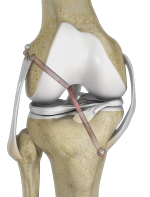 Knee Ligament Reconstruction 