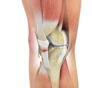 Patellar Tendon Tear