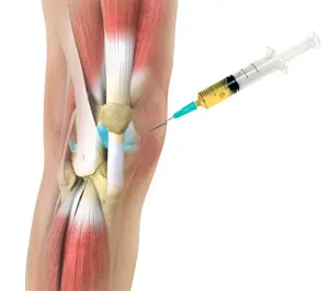 Platelet Rich Plasma (PRP) Injections for the Knee