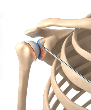 Removal of Bone Spurs