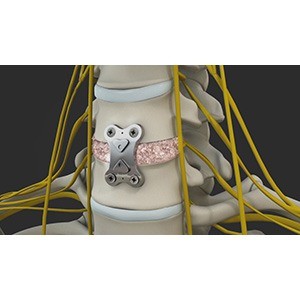 Anterior Cervical Discectomy with Fusion pic