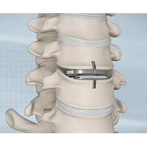 Artificial Cervical Disc Replacement pic
