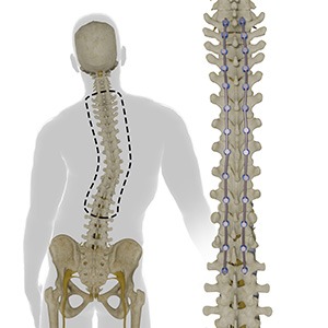 Complex Spinal Reconstruction pic