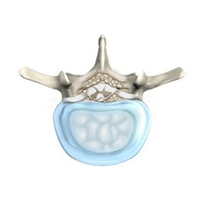 Degenerative Disc Disease pic