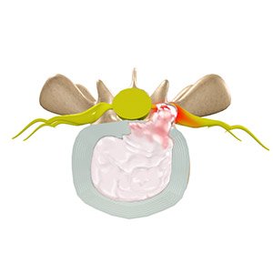 Herniated Disc pic