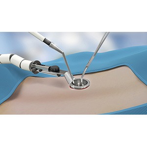 Minimally Invasive Spine Surgery pic