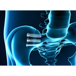 Sacroiliac Joint Arthrodesis pic
