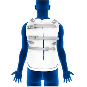 Scoliosis Treatment pic